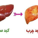بیماری کبد چرب و تاثیرات آن بر بدن و راه های پیشگیری و درمان آن