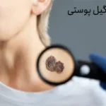 انواع زگیل پوستی + 8 راه درمان زگیل پوستی