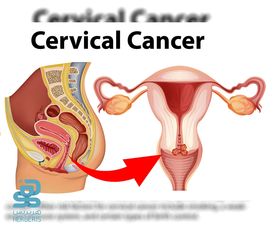 سرطان دهانه رحم