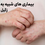 بیماری شبیه به زگیل تناسلی! زنگ خطر ، اشتباه نگیرید!!!