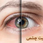 حساسیت چشم یا آلرژی چشمی چیست؟ | معرفی 6 نوع حساسیت چشم