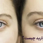 آب مروارید چیست؟ | 7 علت ابتلا به آب مروارید